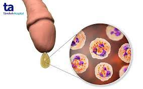 Cách dùng thuốc đặt trong điều trị viêm âm đạo và cổ tử cung khi mang thai